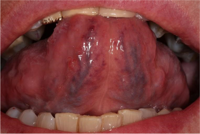 Sublingual Varis Skorlaması