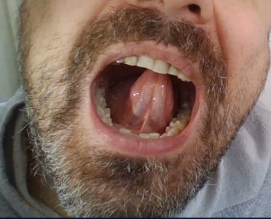 Sağlıklı Dil Altı Örneği